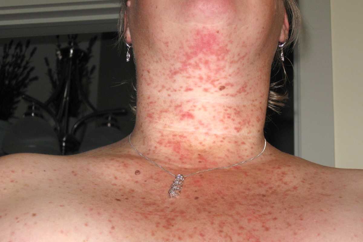 Urticaire ©Mastocytosis Canada CC BY-NC-ND 2.0