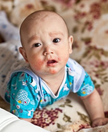 Allergies alimentaires ©linavita shutterstock