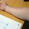 Prick test ©wikipedia