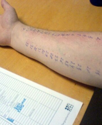 Prick test ©wikipedia